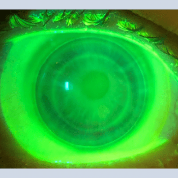 Hybrid Lens Keratoconus