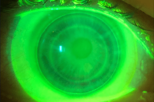 Hybrid Lens Keratoconus