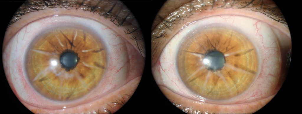 Scleral Lens Post-Refractive Keratotomy