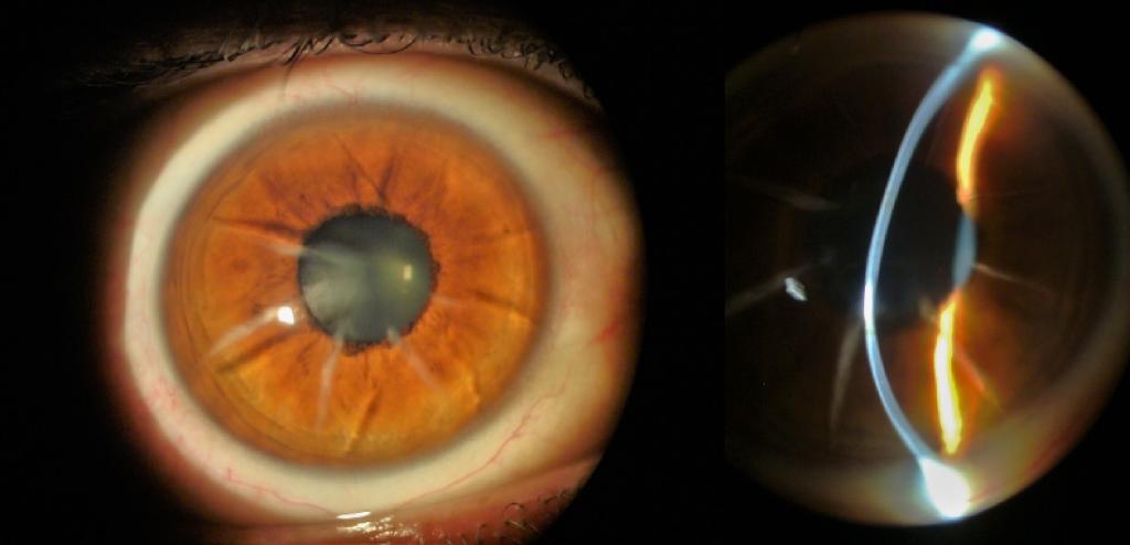 Scleral Lens Post-Refractive Keratotomy