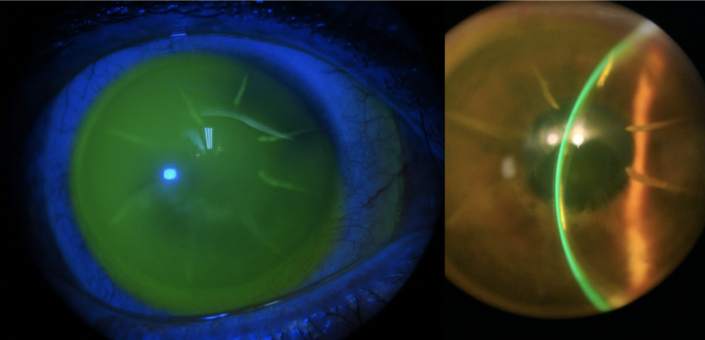 Scleral Lens Post-Refractive Keratotomy