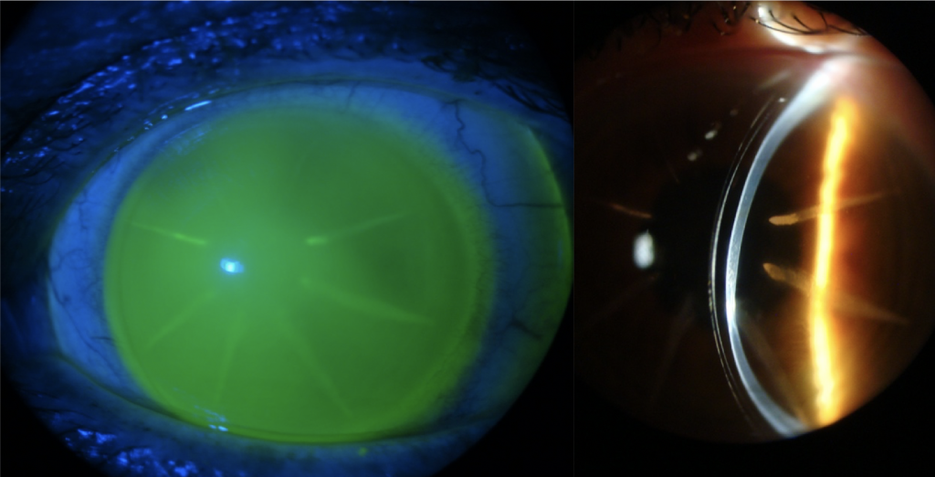 Scleral Lens Post-Refractive Keratotomy
