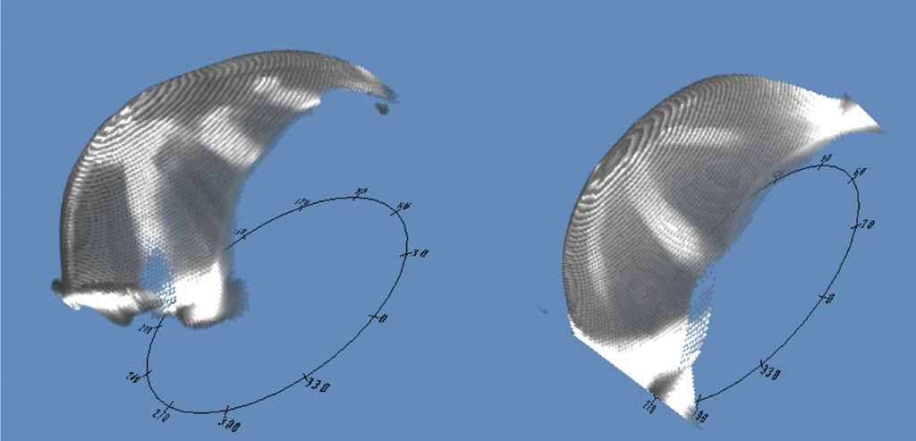 3D Corneal Model images from Pentacam