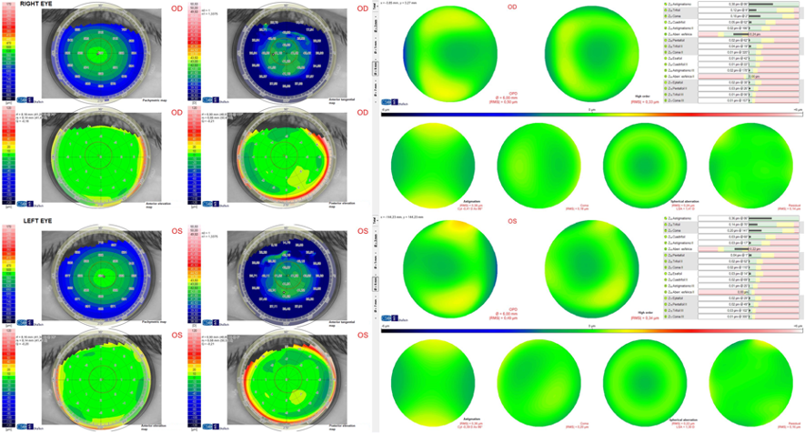 Successful Visual Restoration of Presbyopia with a New Customized  Multifocal Corneo-Scleral Contact Lens - Global Insight