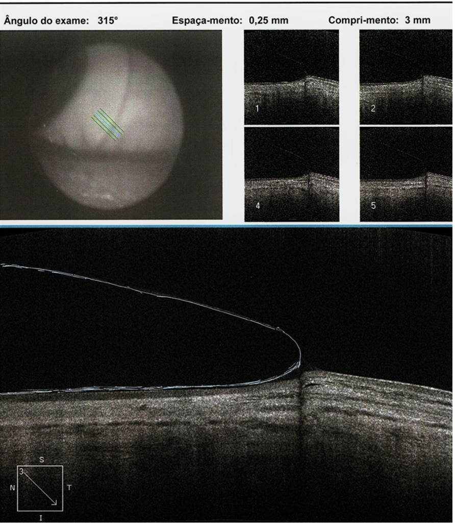 Scleral Lens Post-Refractive Keratotomy