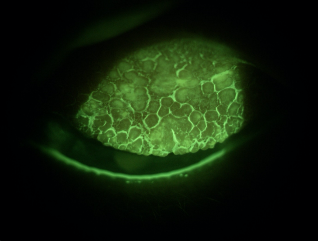 Grade 4 Giant Papillary Conjunctivitis