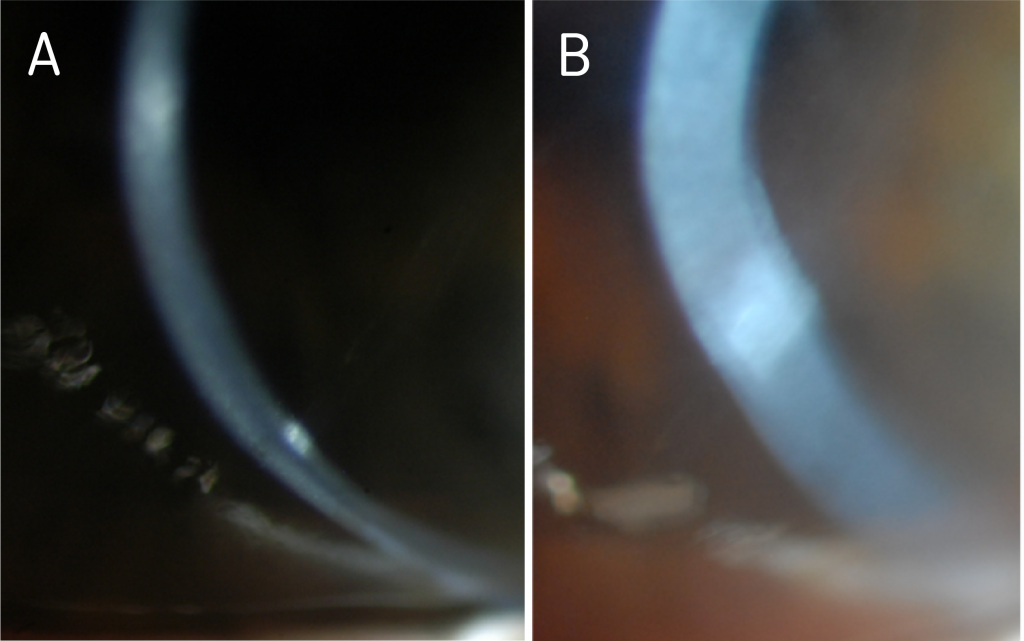 Reducing Suction and Maximizing Oxygen Permeability