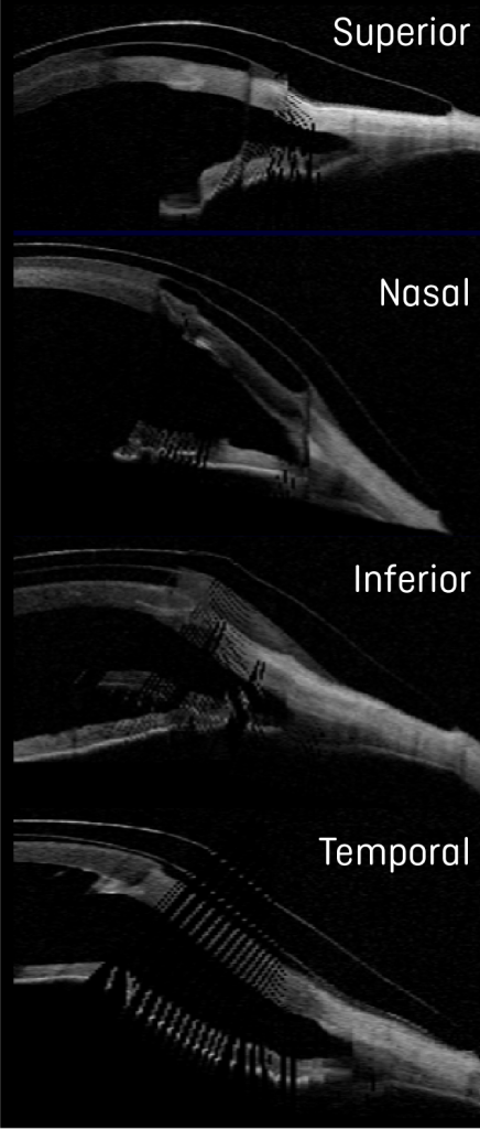 Reducing Suction and Maximizing Oxygen Permeability