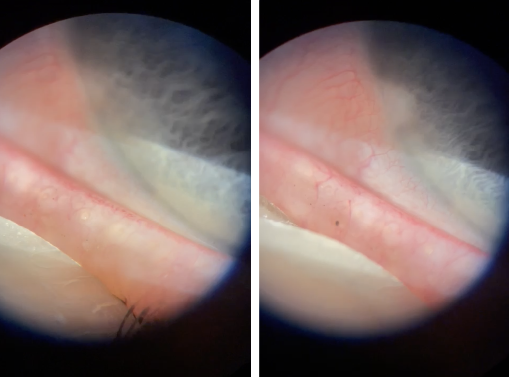 Soft Lens Dropout Patient