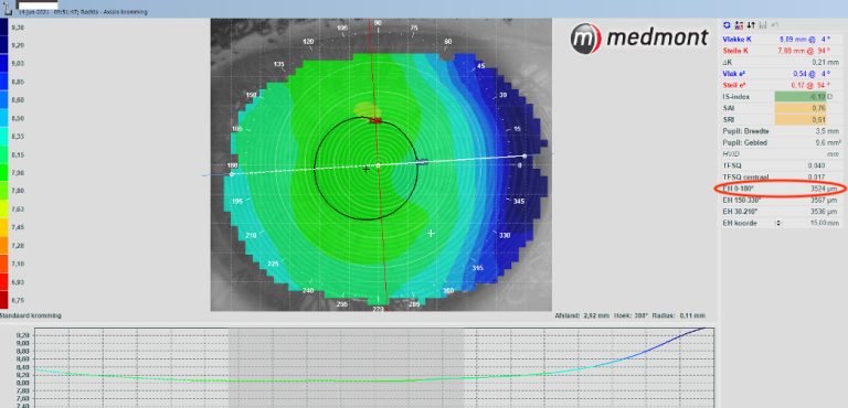 Medmot software which help fit a customised soft lens