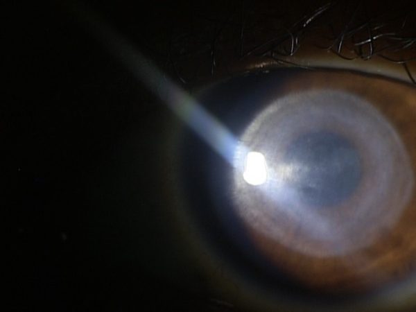 Slit lamp photo showing a 6mm round central stromal scar OS secondary to microbial keratitis.