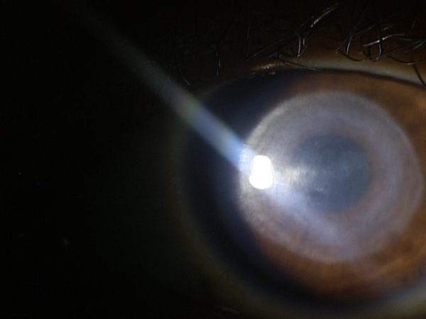 Slit lamp photo showing a 6mm round central stromal scar OS secondary to microbial keratitis.