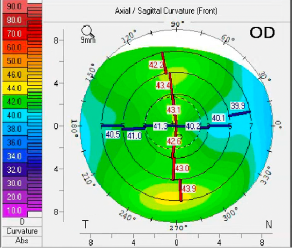 Axial map showing central corneal flattening secondary to microbial keratitis in the left eye.