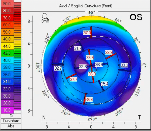 Axial map showing with-the-rule astigmatism in the right eye.