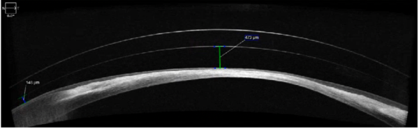 An AS-OCT of a prolate diagnostic scleral lens OS showing excessive central vault with adequate mid-peripheral vault.