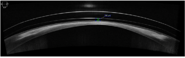 An AS-OCT of an oblate scleral lens design OS showing adequate central clearance after ~6 hours of wear.