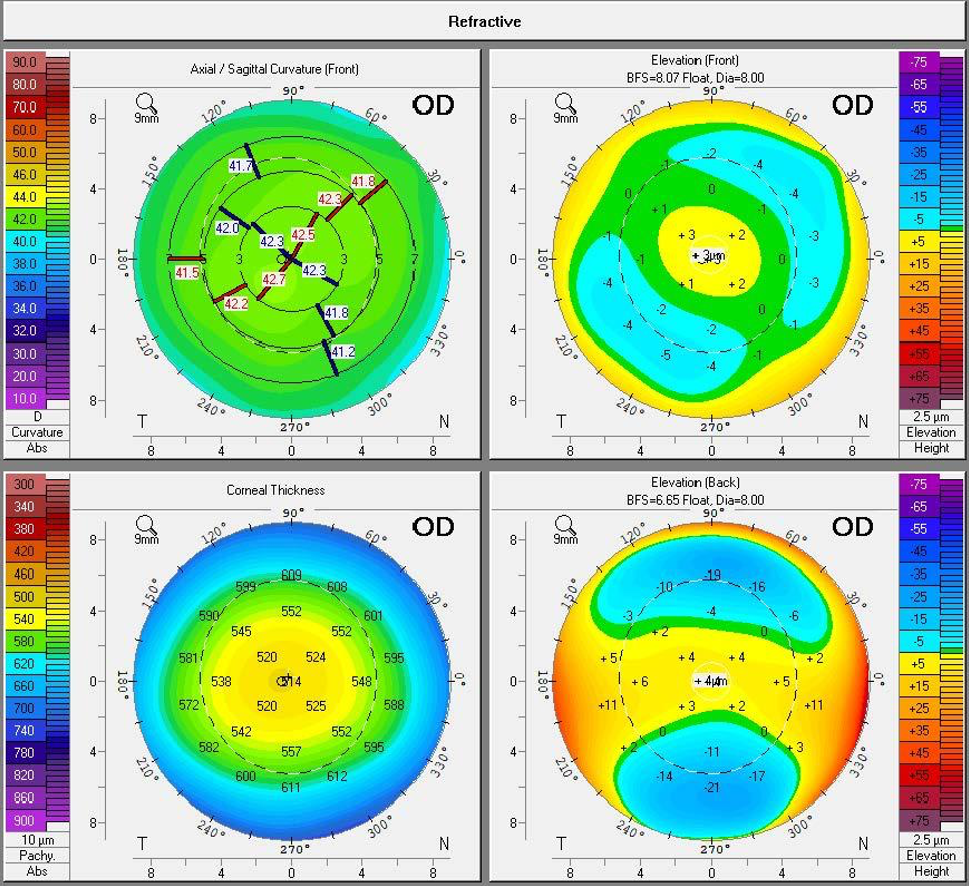 Tomography